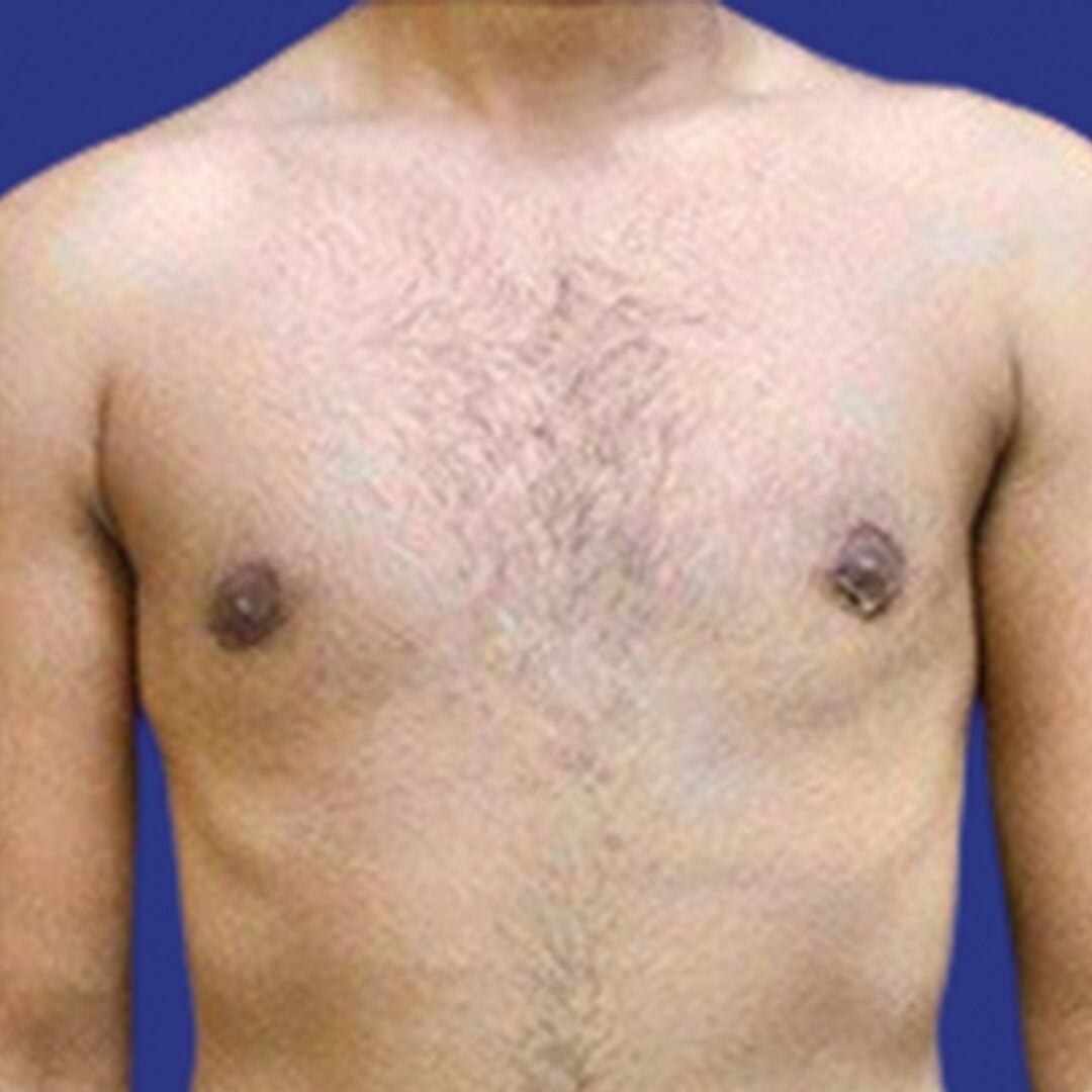 Procedure before and after - after