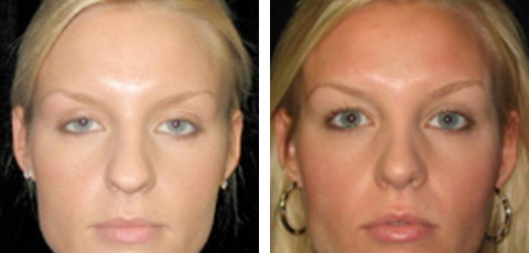 Nose Surgery before and after - after