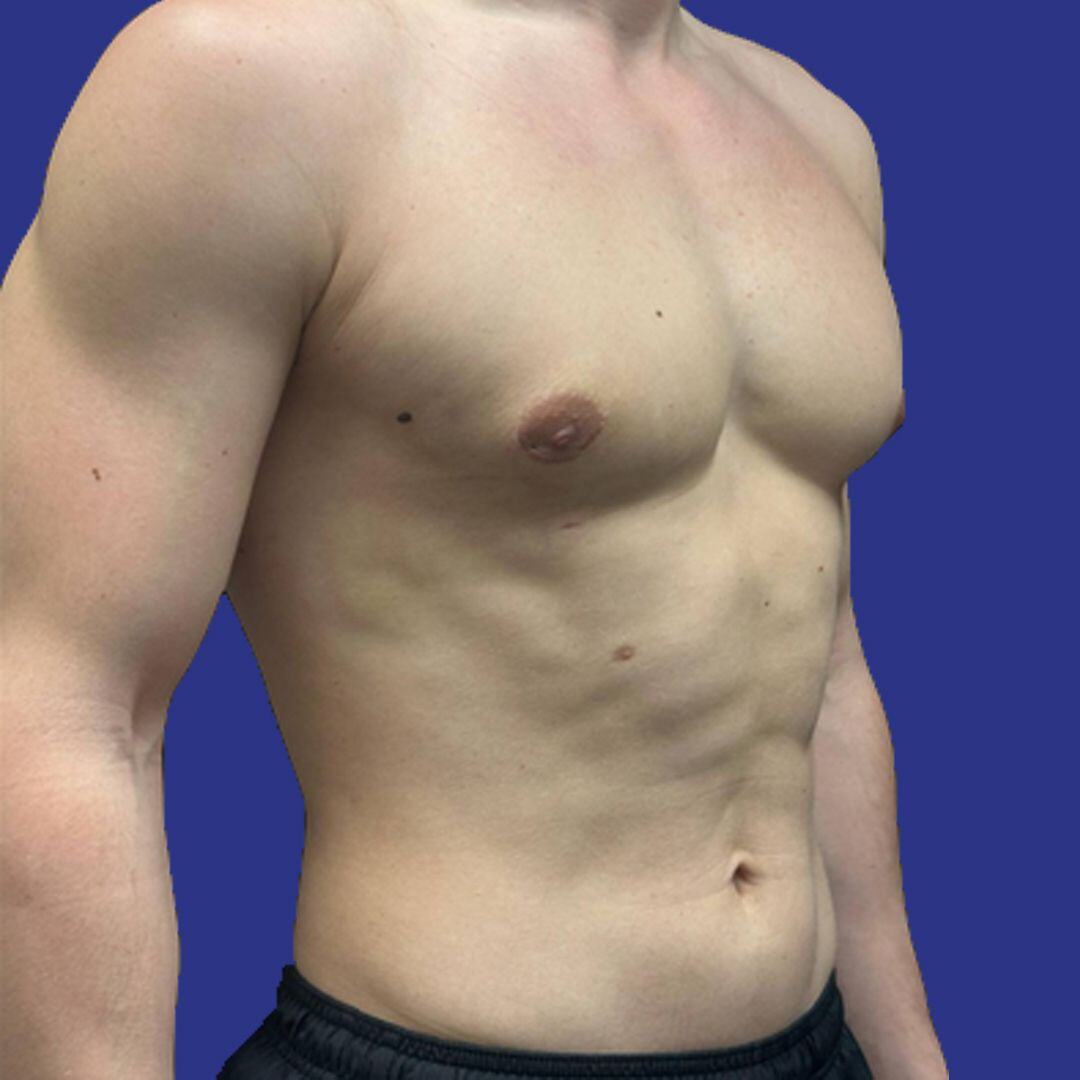 Procedure before and after - after