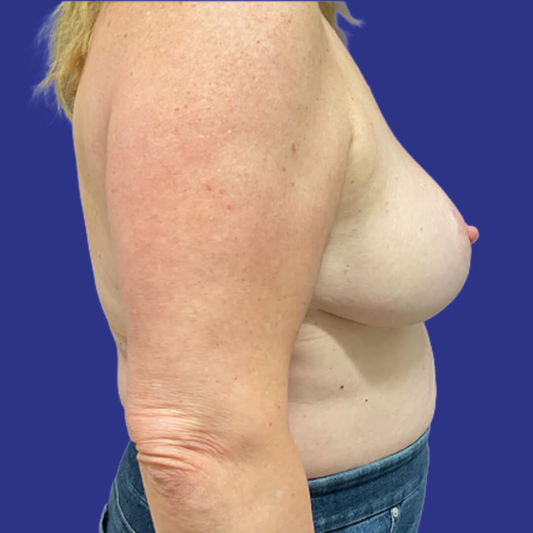 Procedure before and after - after