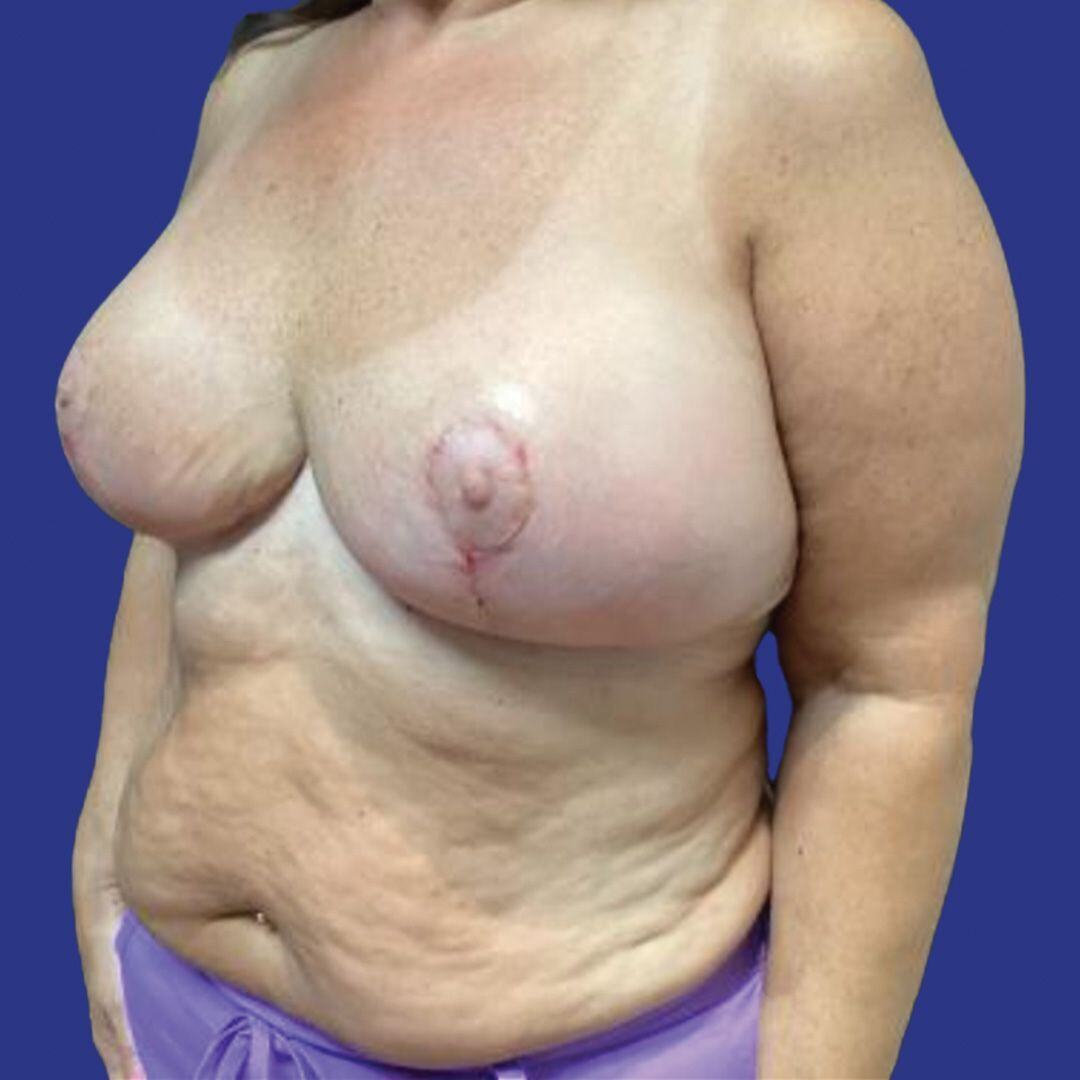 Procedure before and after - after