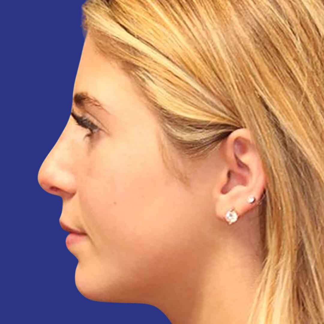 Procedure before and after - after