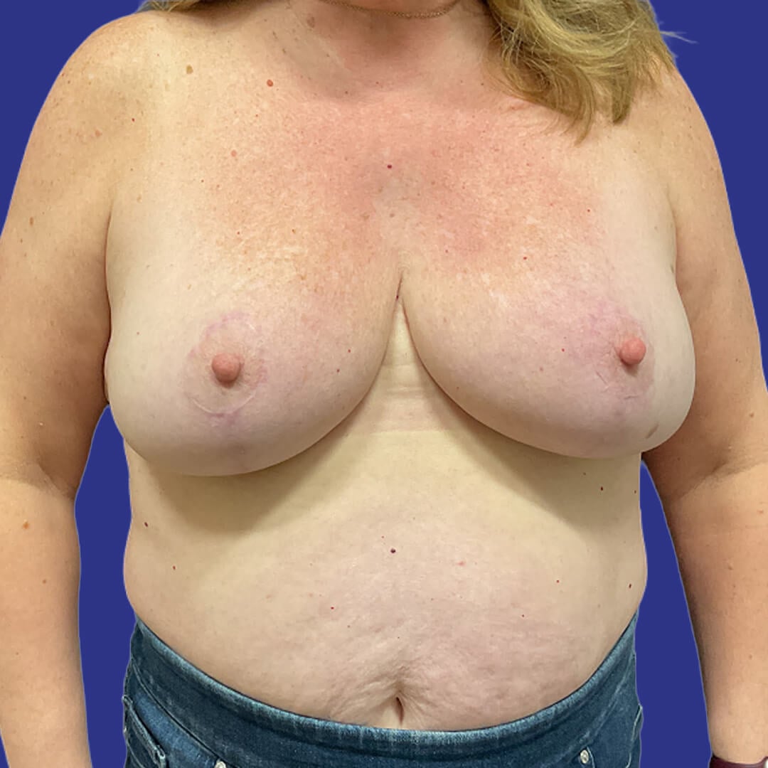 Procedure before and after - after