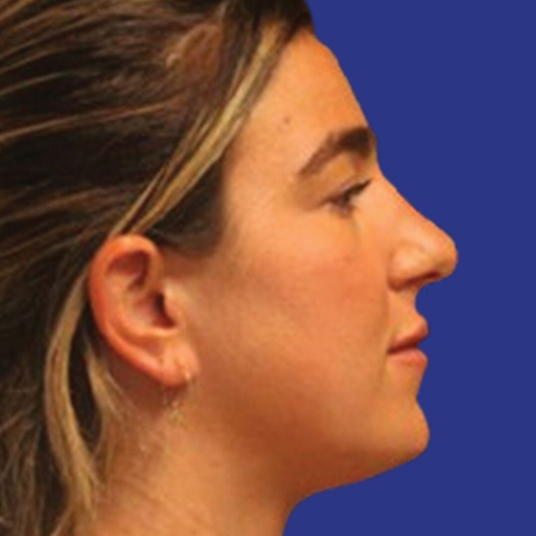 Procedure before and after - before