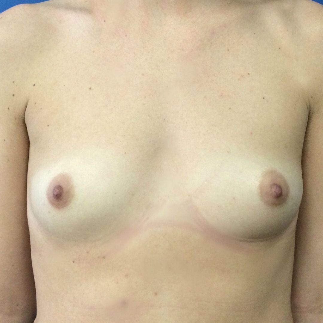 Procedure before and after - before