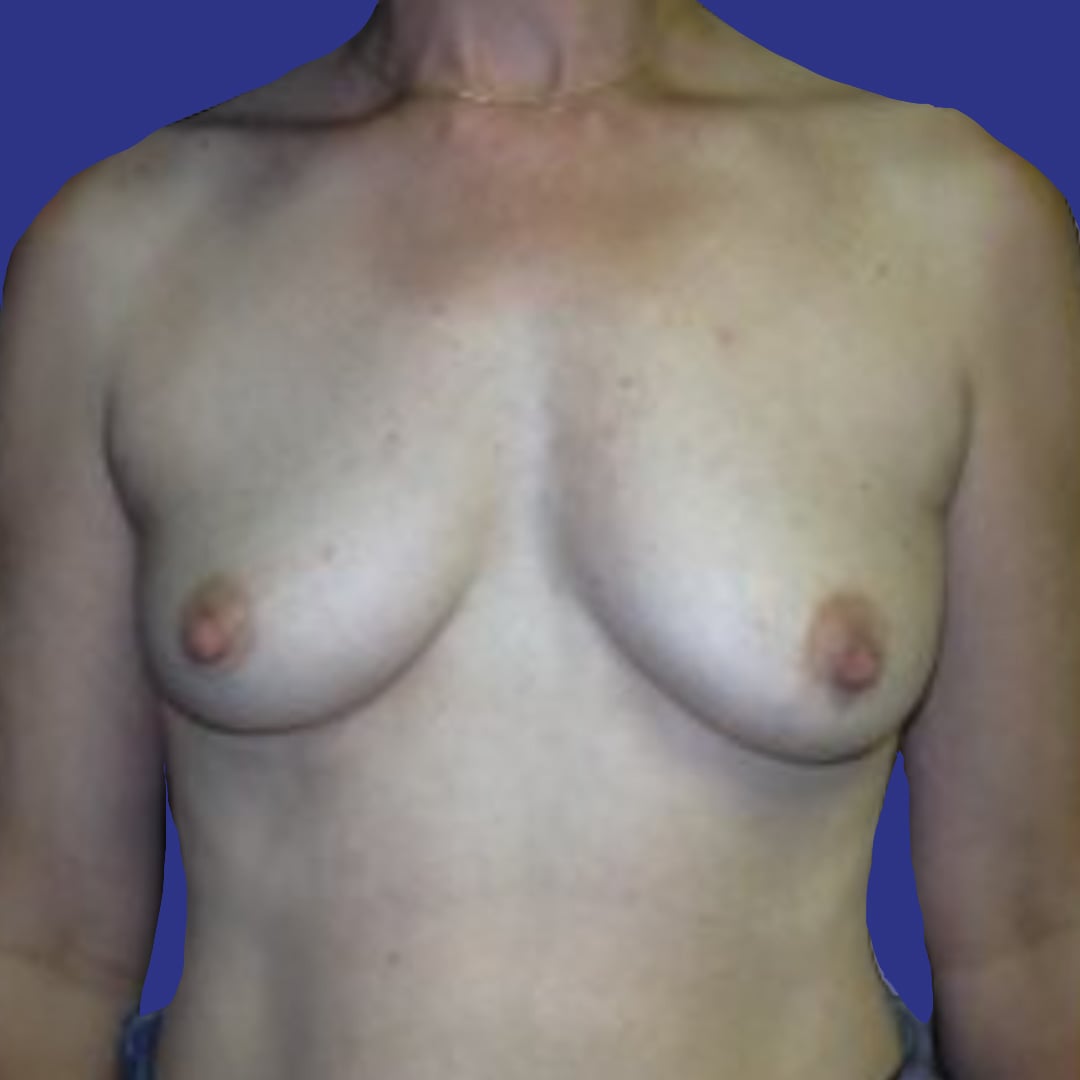 Procedure before and after - before