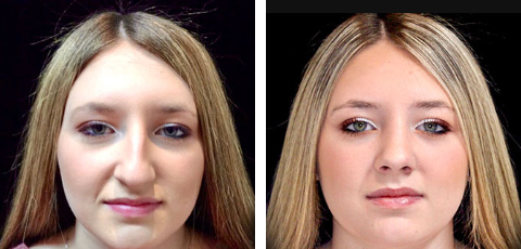 Nose Surgery before and after - before