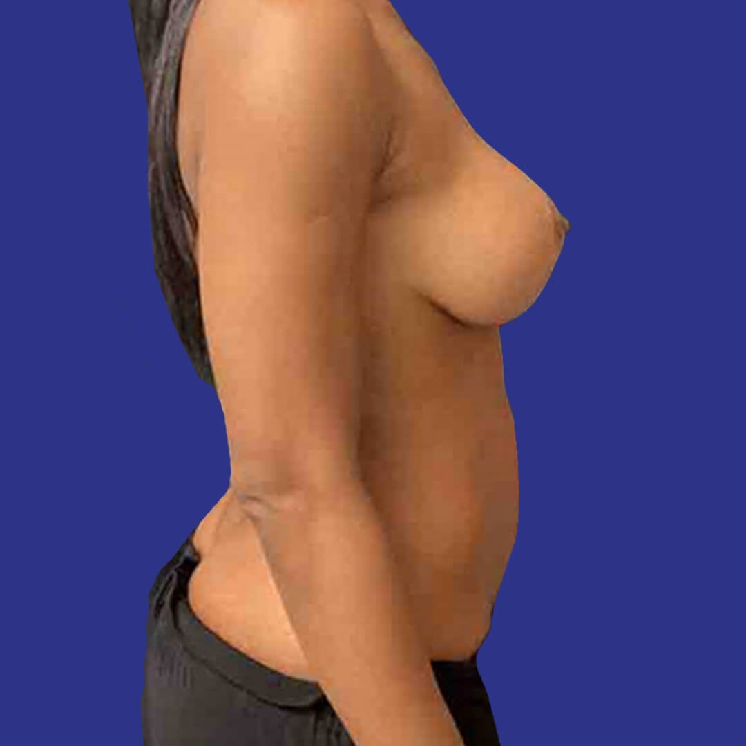 Procedure before and after - before