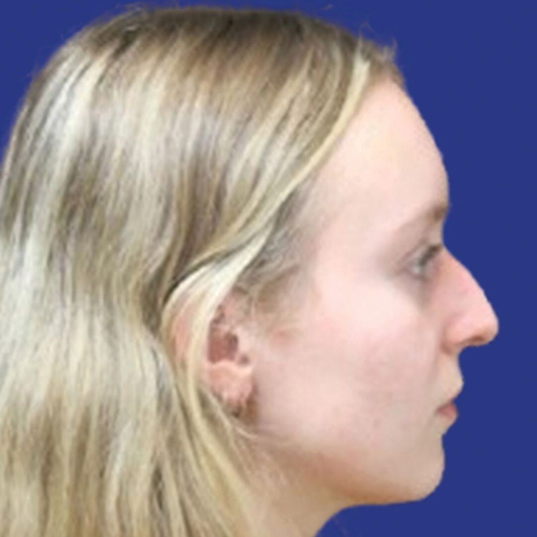 Procedure before and after - before