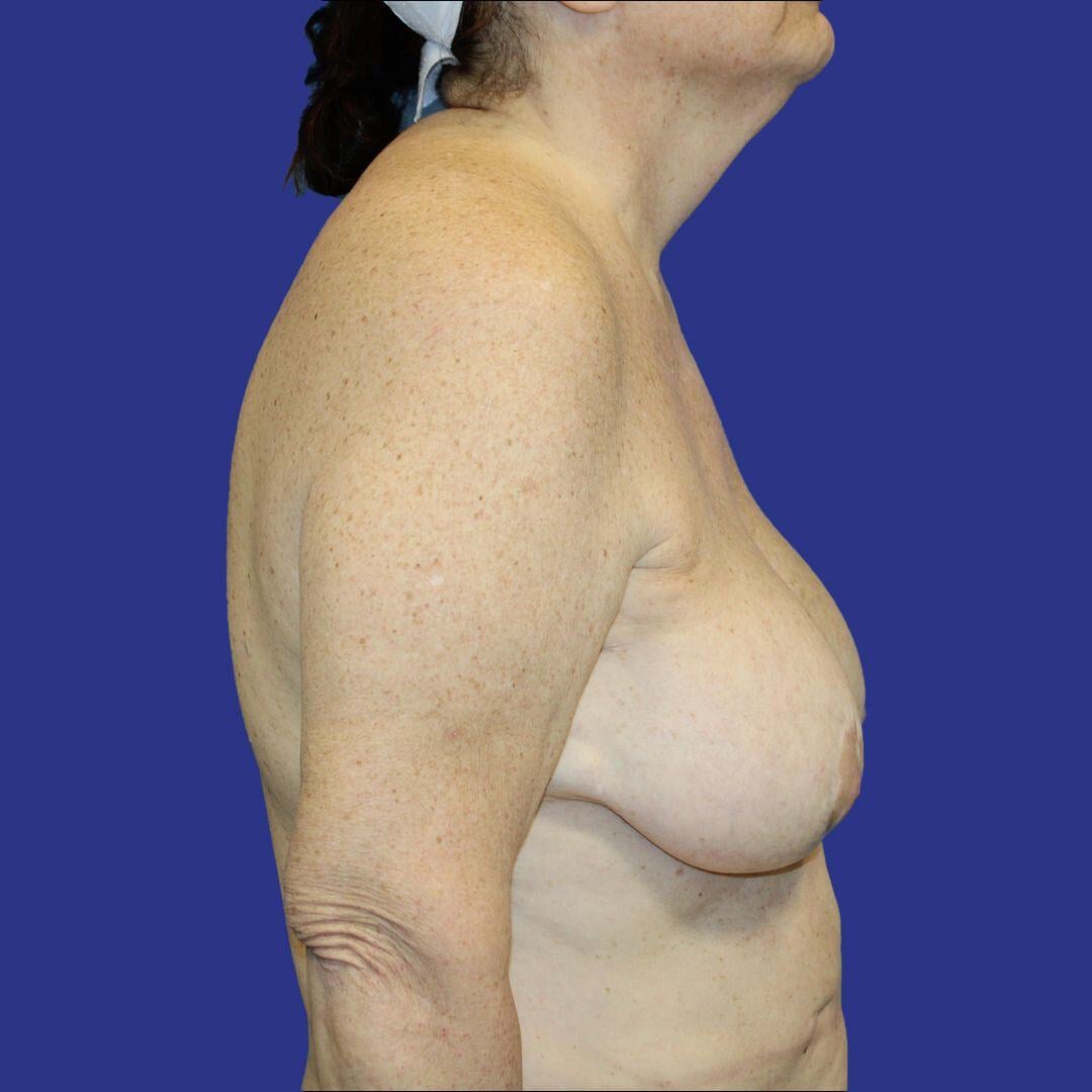 Procedure before and after - before