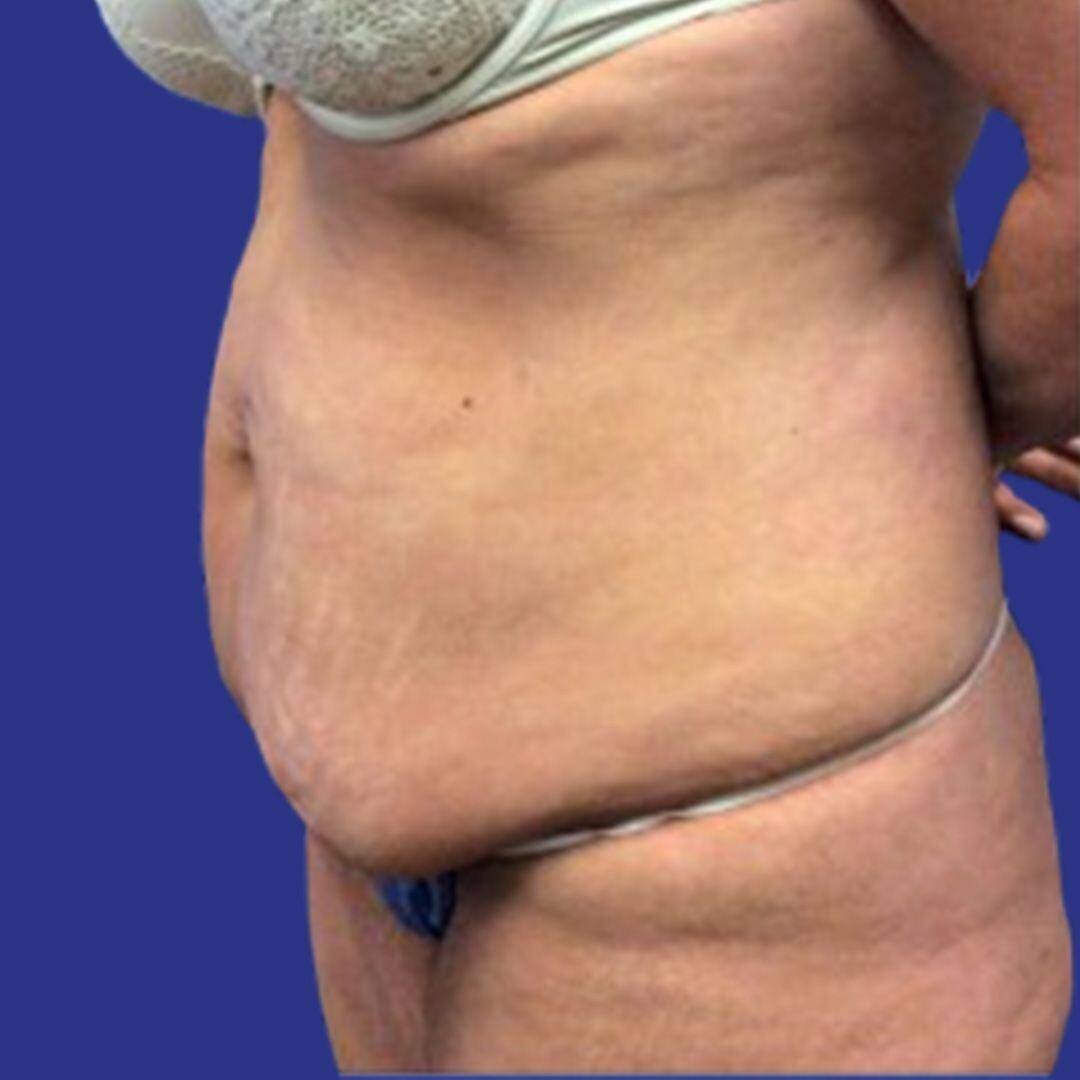Procedure before and after - before