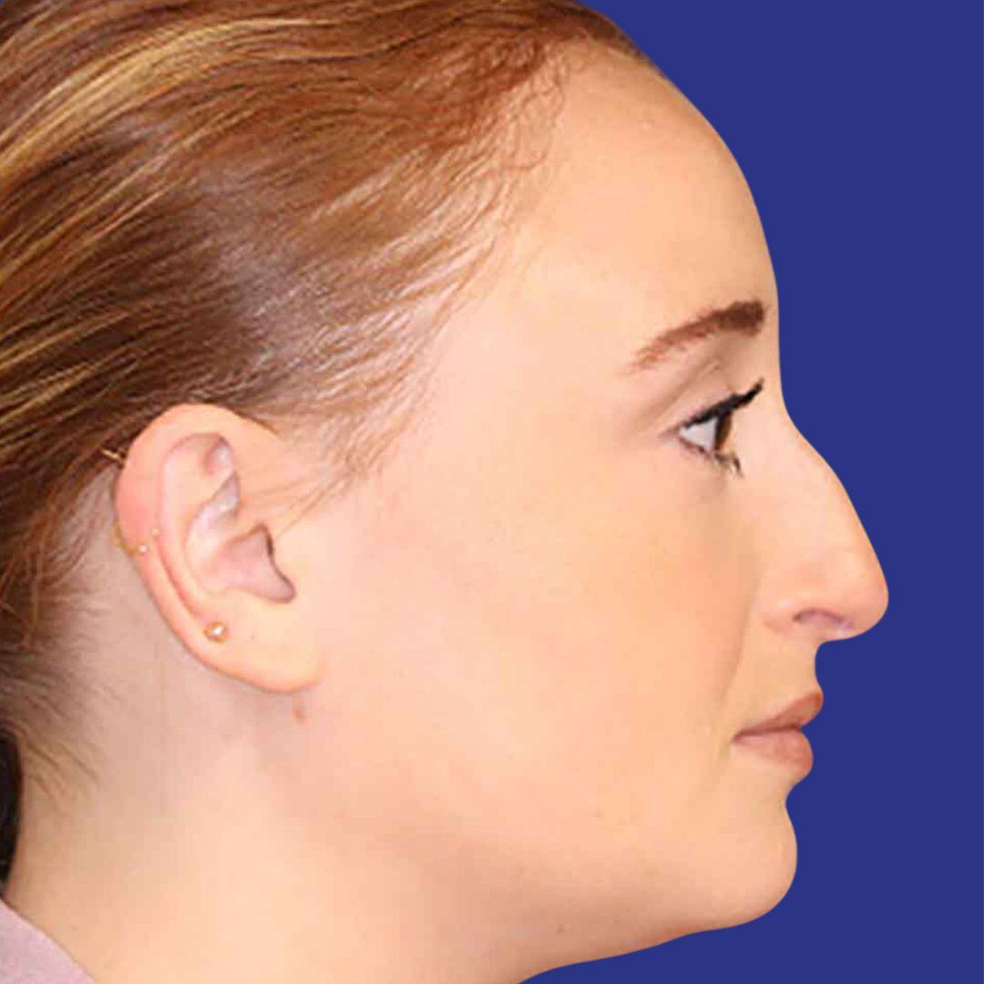 Procedure before and after - before