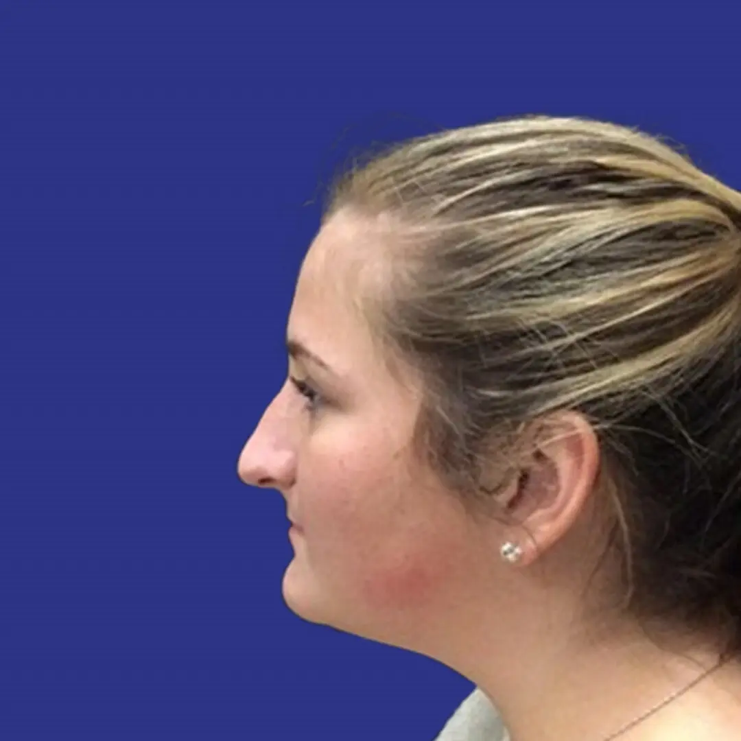 Procedure before and after - before
