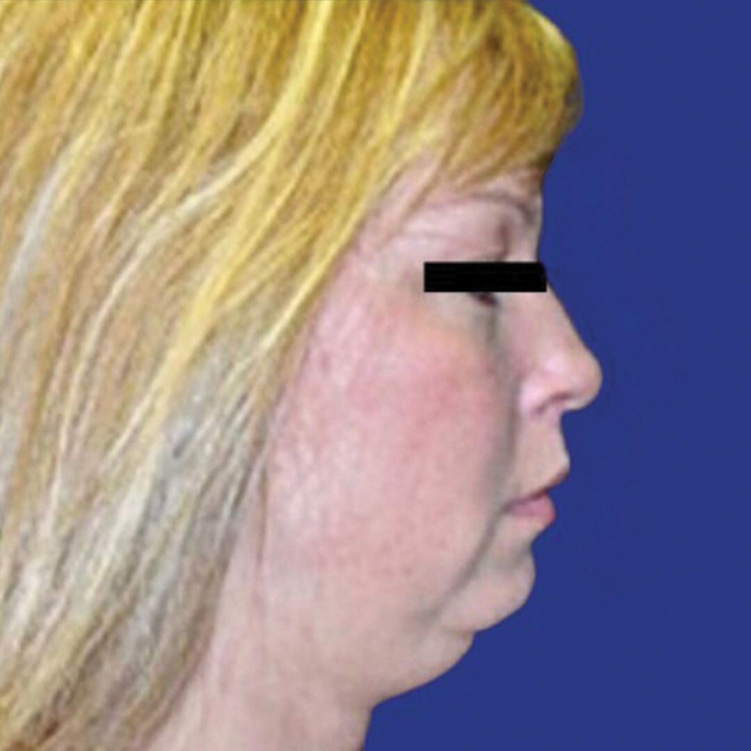 Procedure before and after - before