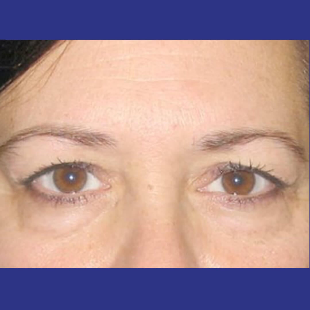 Procedure before and after - before