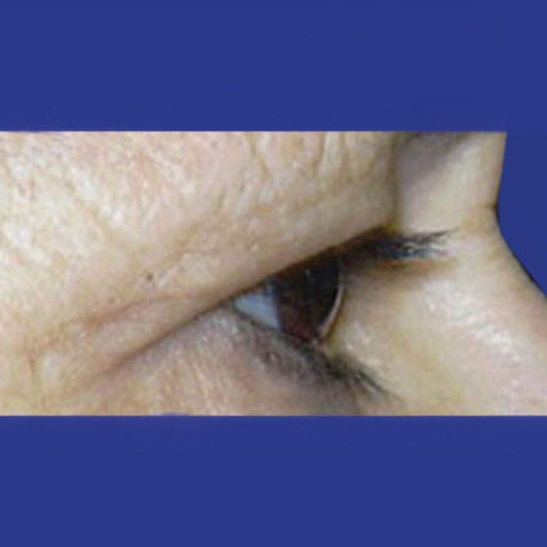 Procedure before and after - before