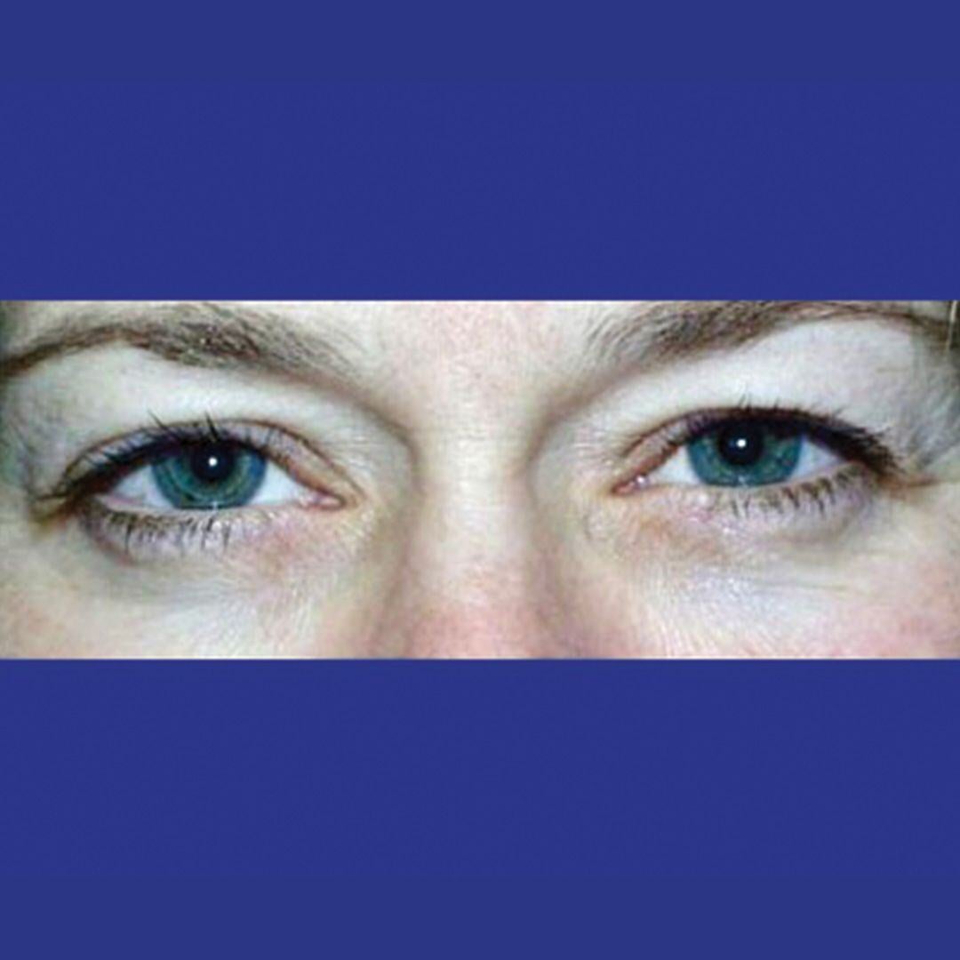 Procedure before and after - before