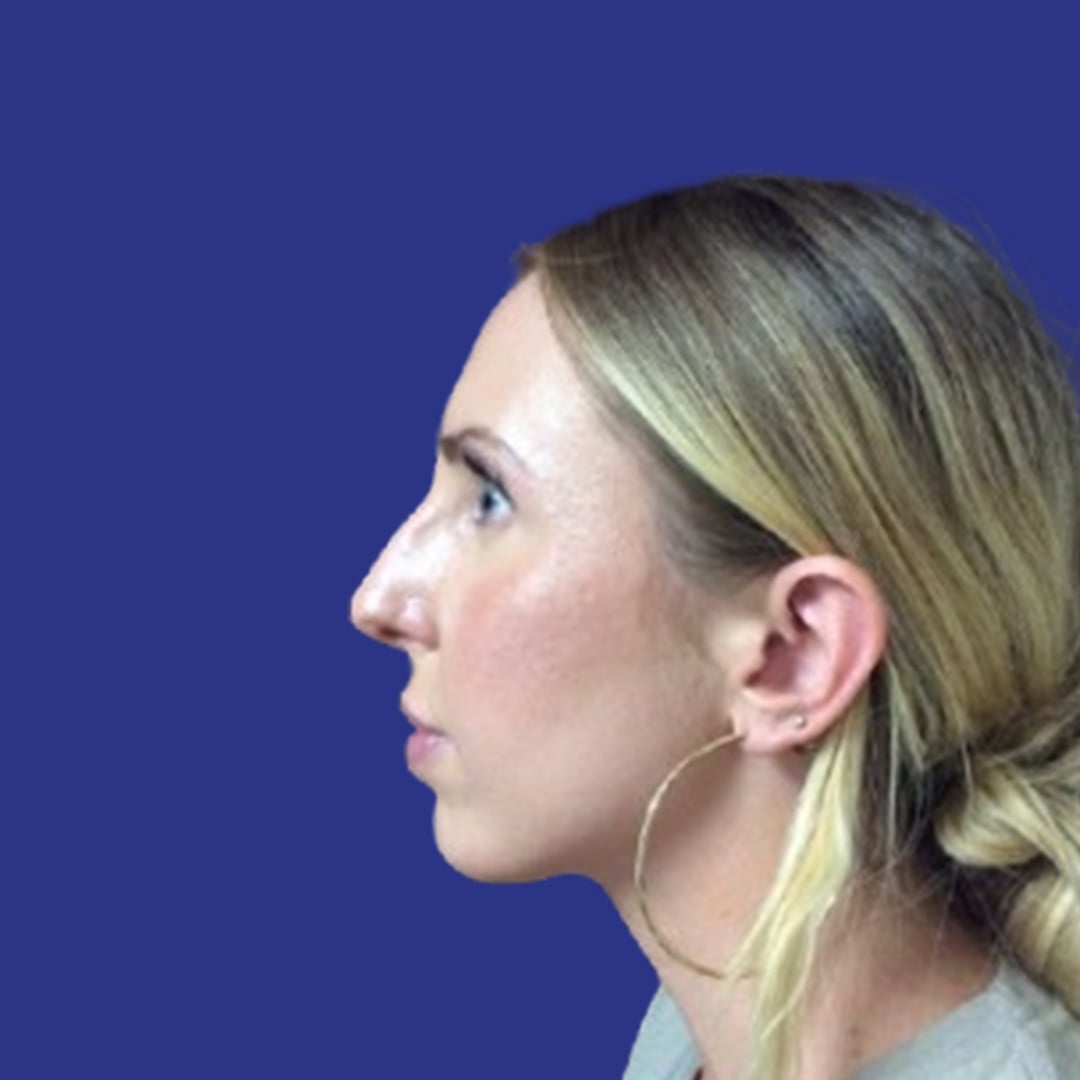 Procedure before and after - before