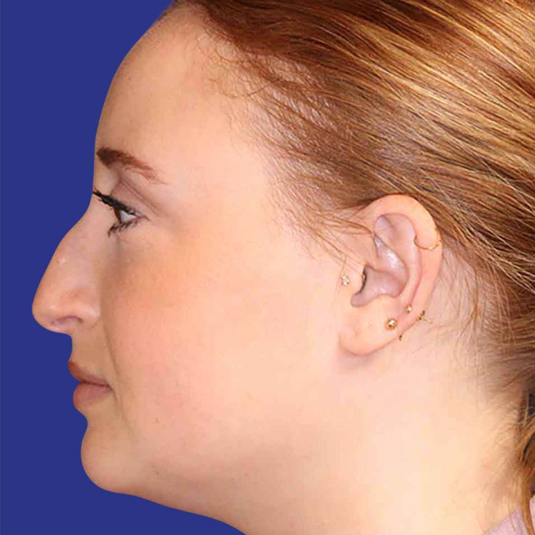 Procedure before and after - before