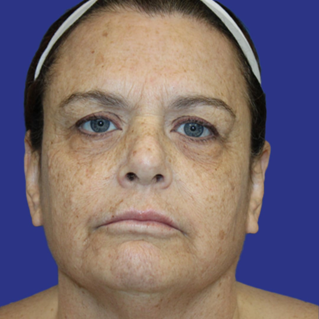 Procedure before and after - before