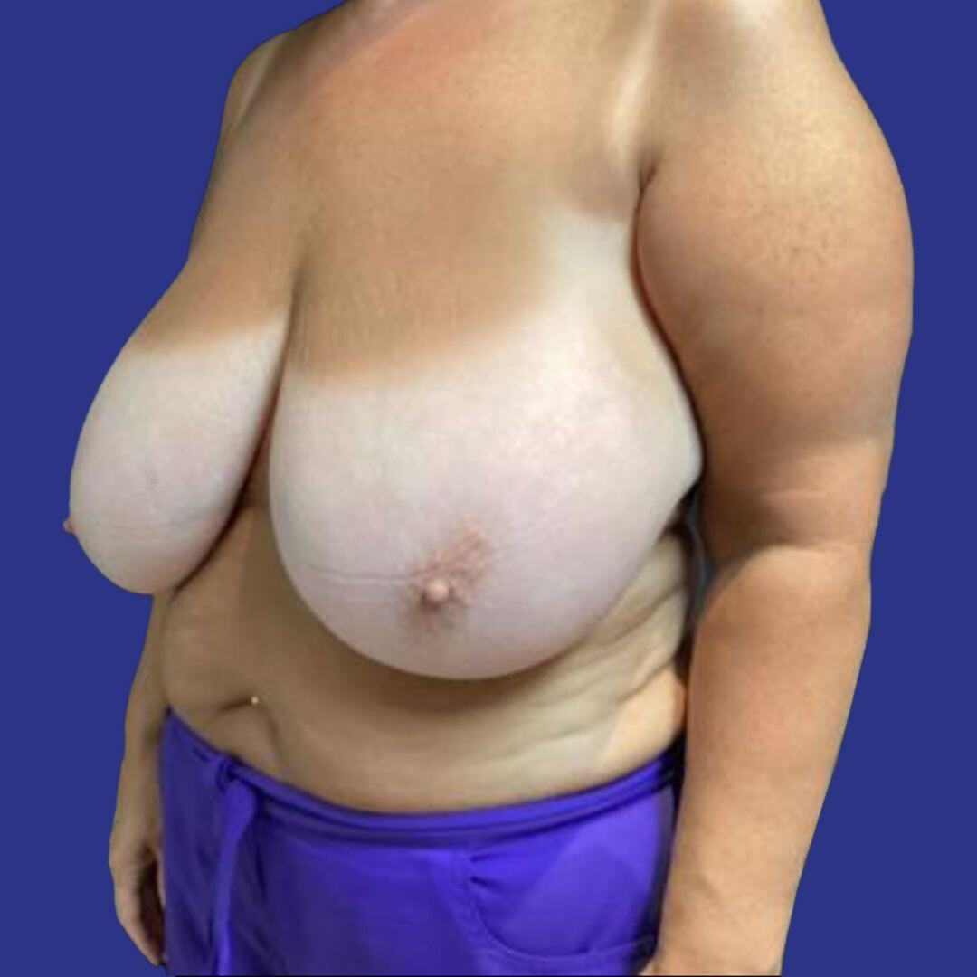 Procedure before and after - before