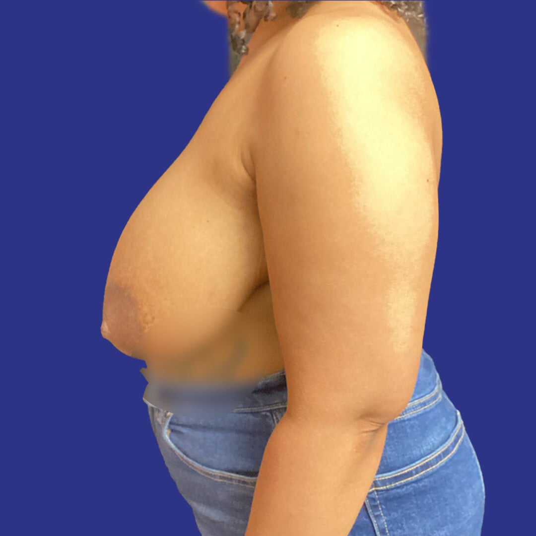 Procedure before and after - before