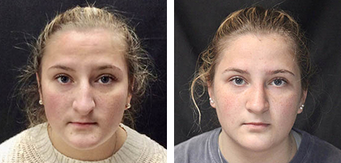Nose Surgery before and after - before
