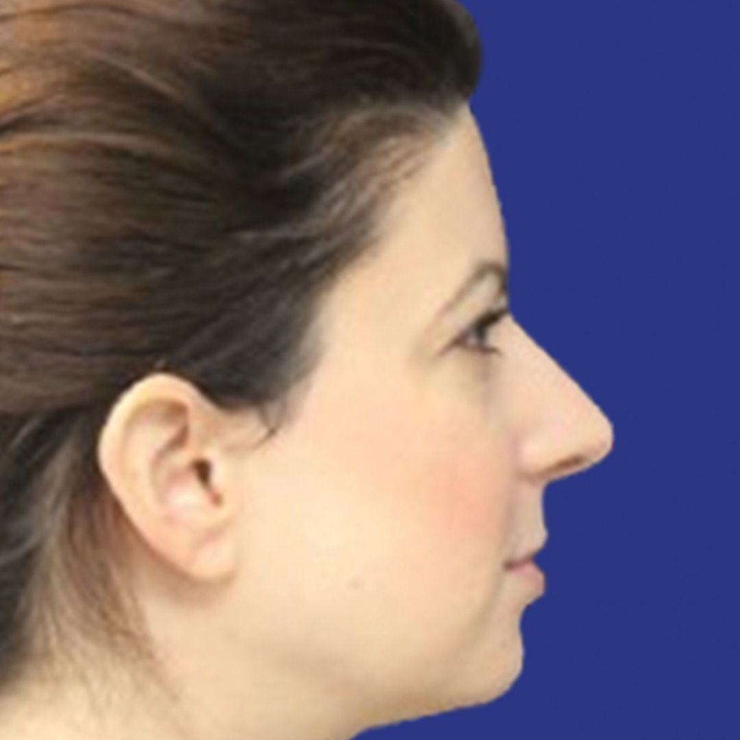 Procedure before and after - before