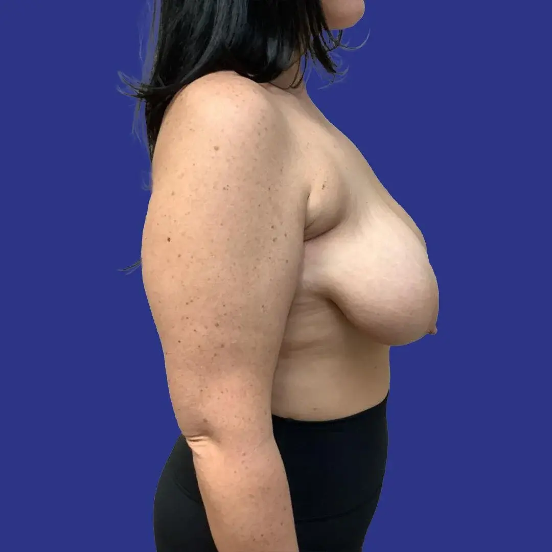 Procedure before and after - before