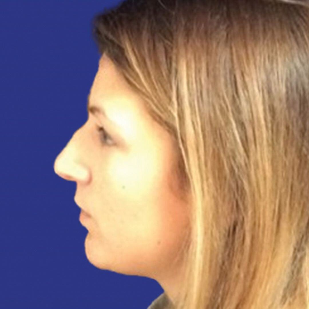Procedure before and after - before