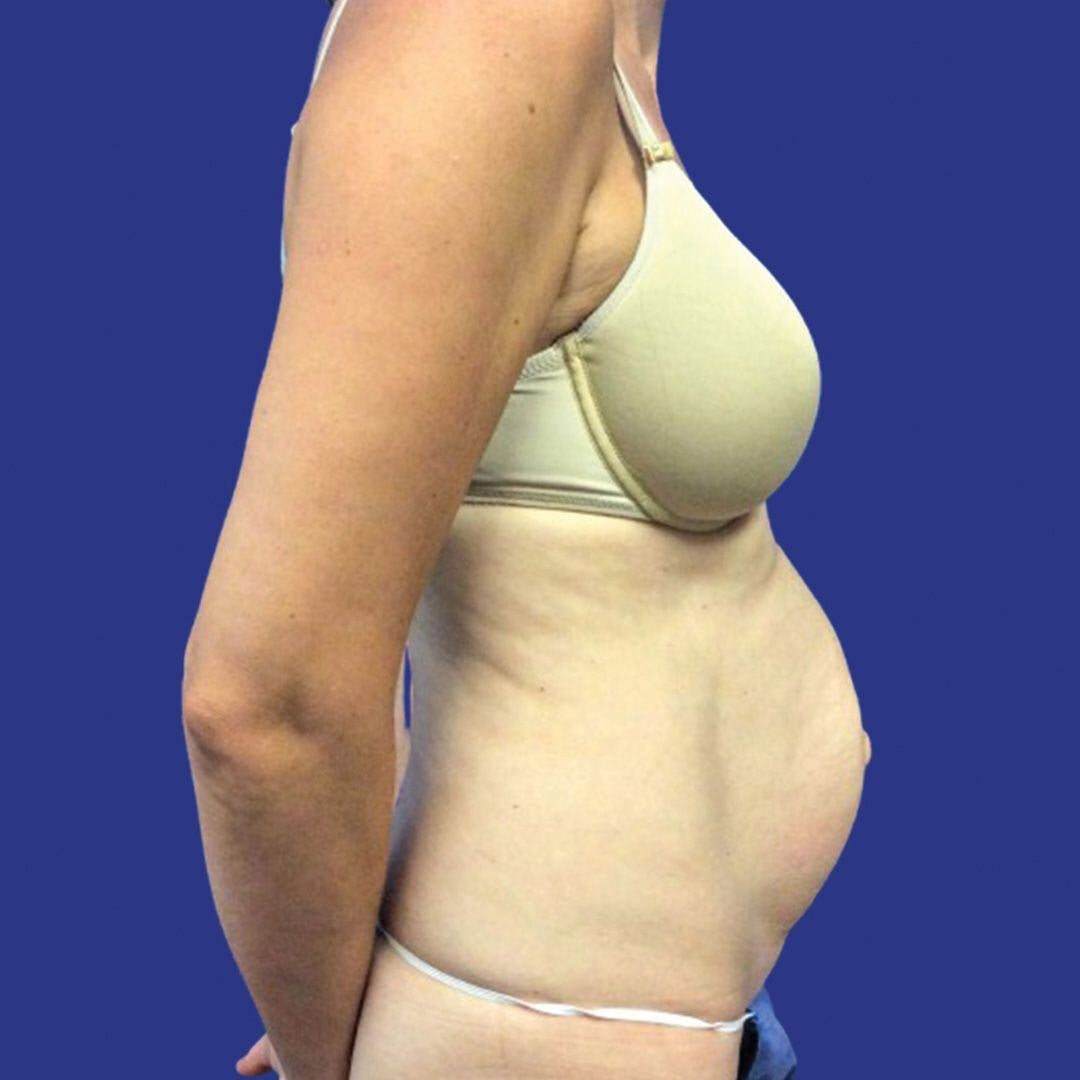 Procedure before and after - before