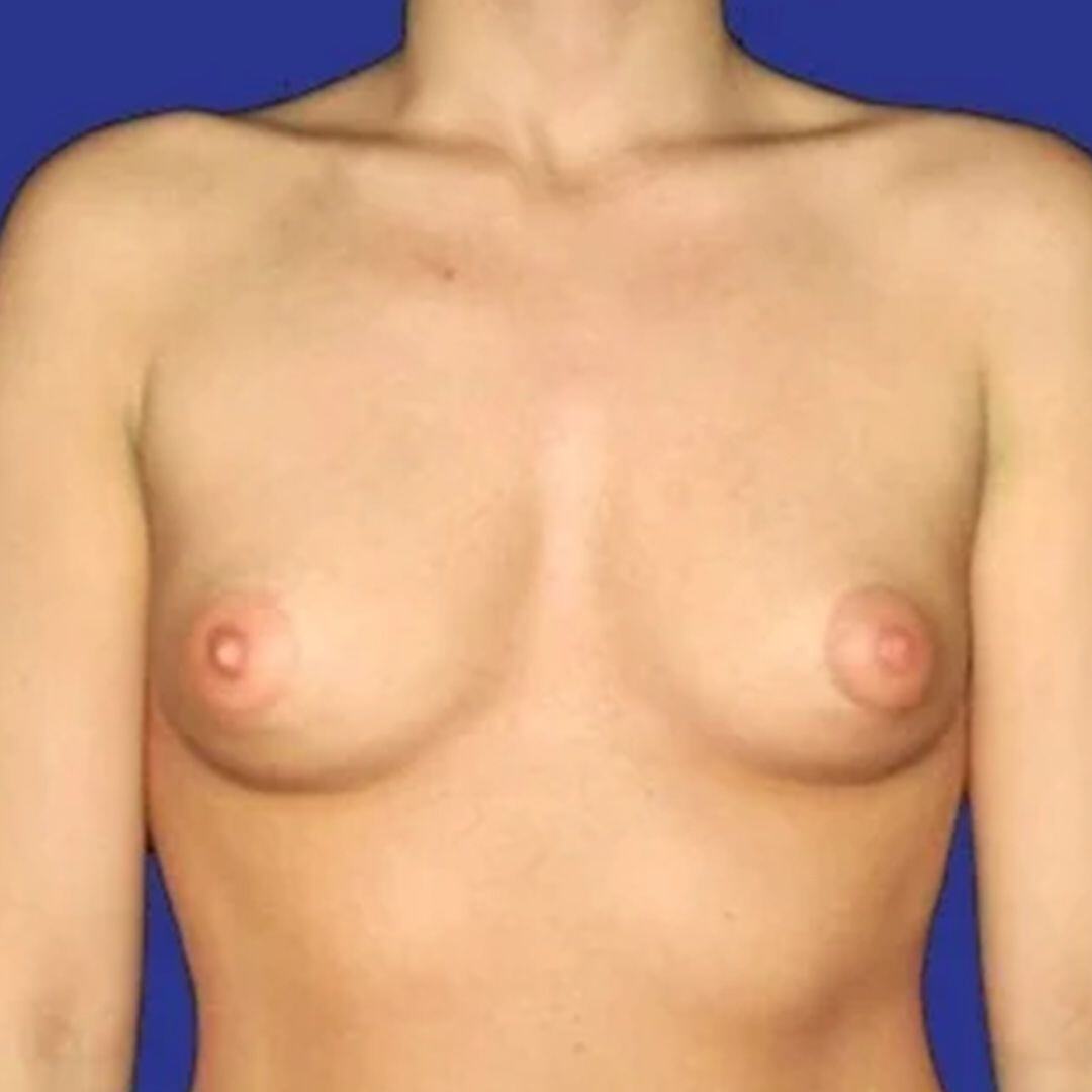 Procedure before and after - before