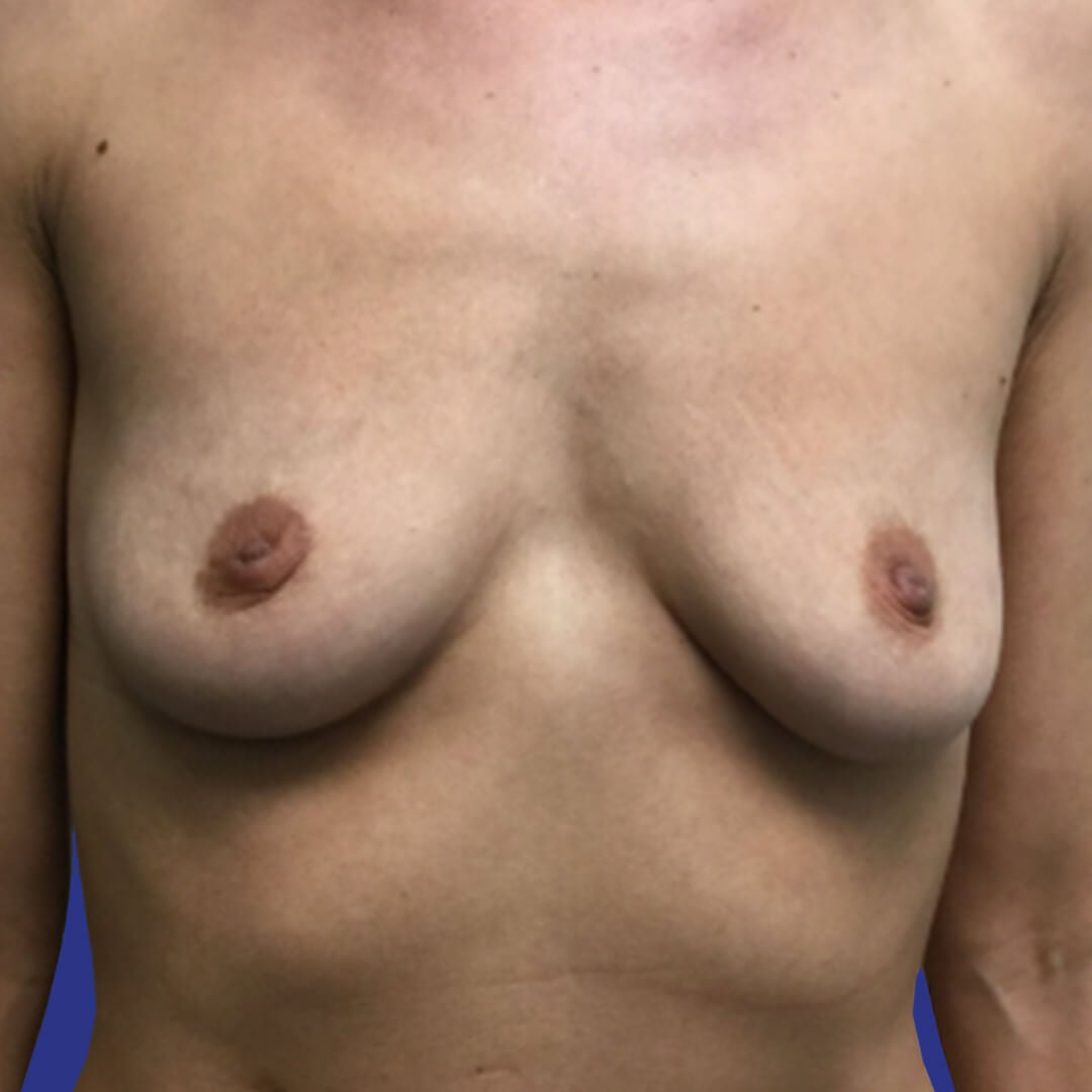 Procedure before and after - before