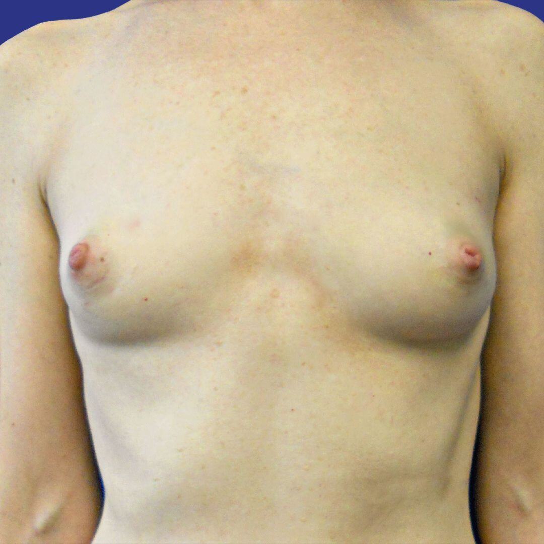 Procedure before and after - before