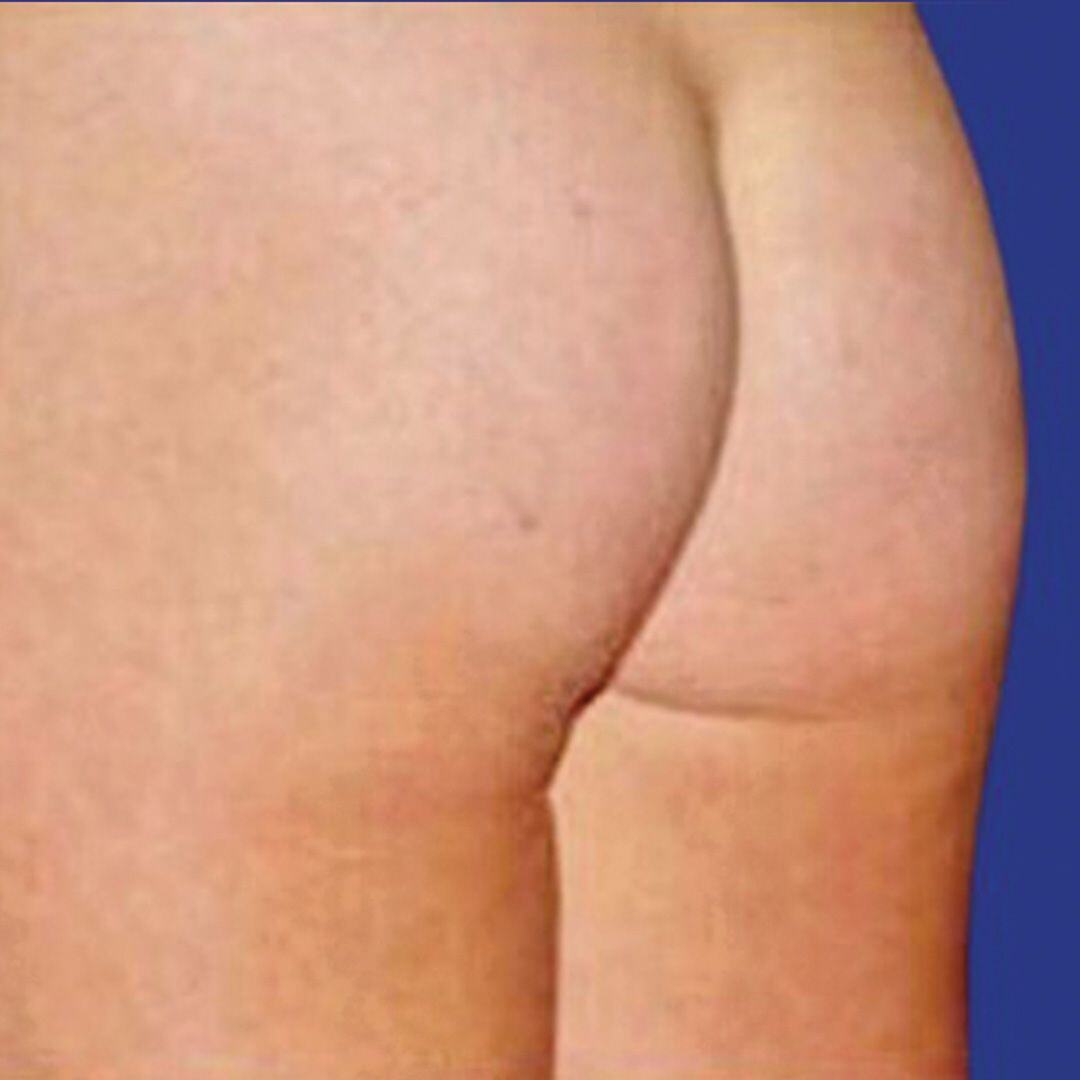 Procedure before and after - before