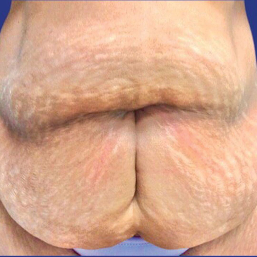 Procedure before and after - before