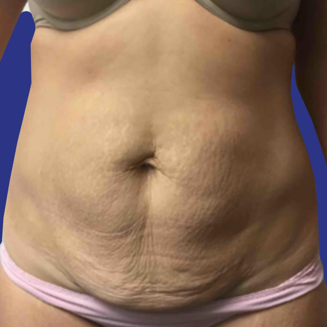 Procedure before and after - before