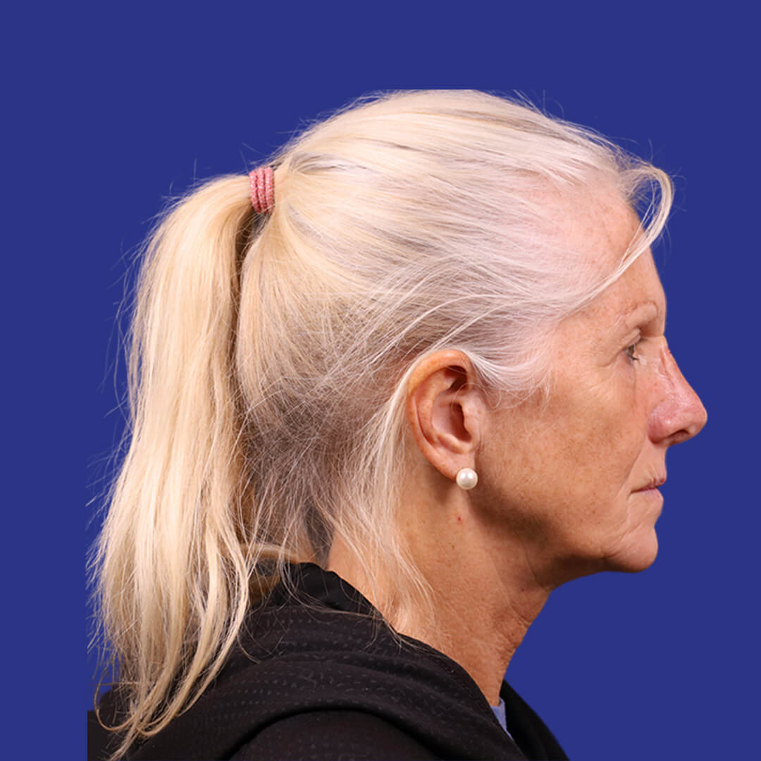 Procedure before and after - before