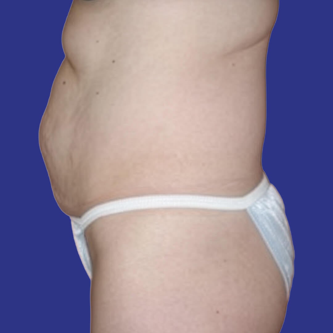 Procedure before and after - before