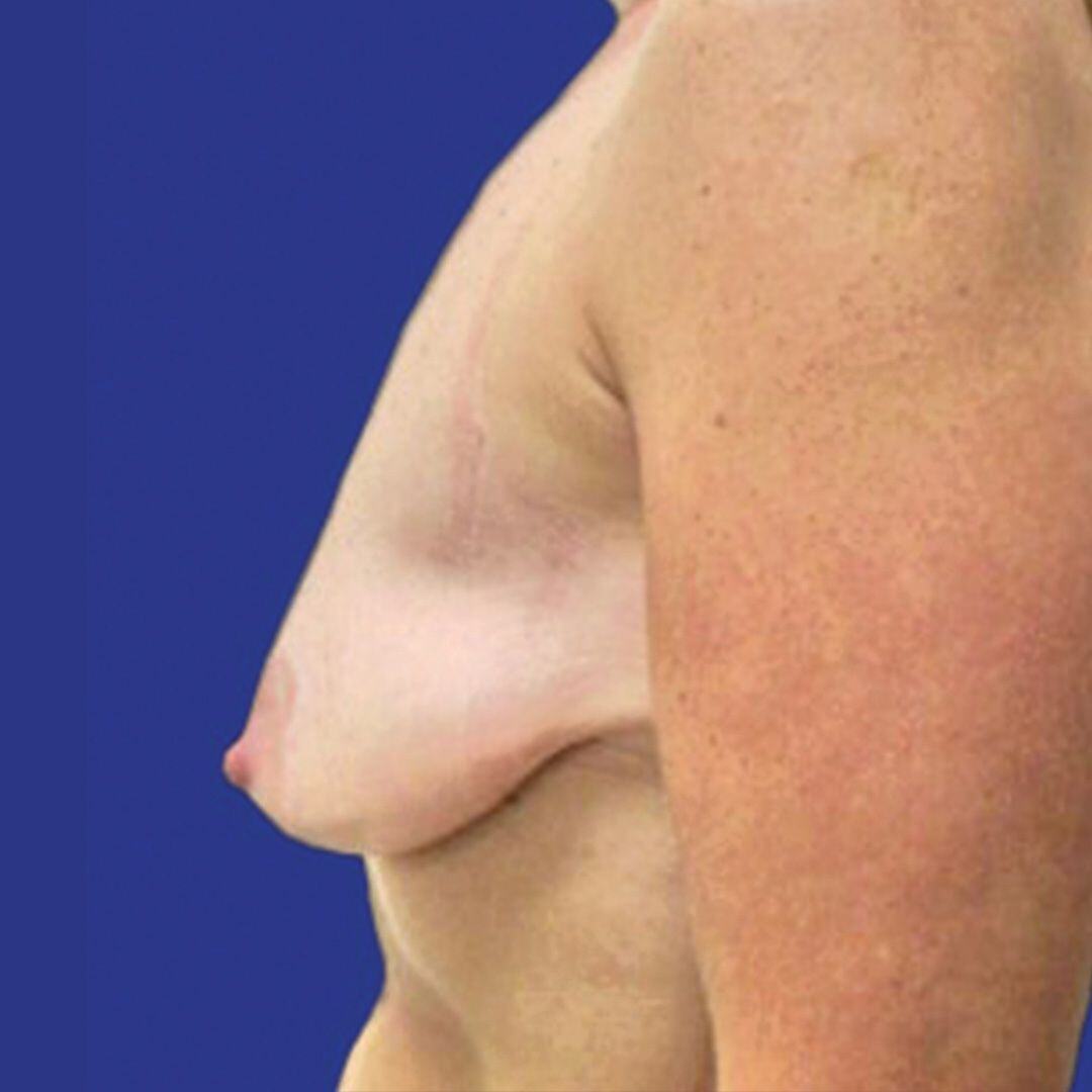 Procedure before and after - before