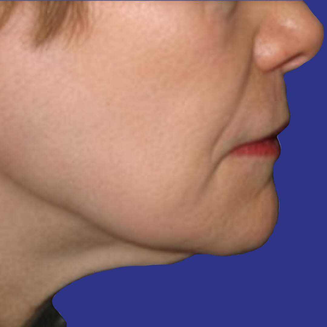 Procedure before and after - before