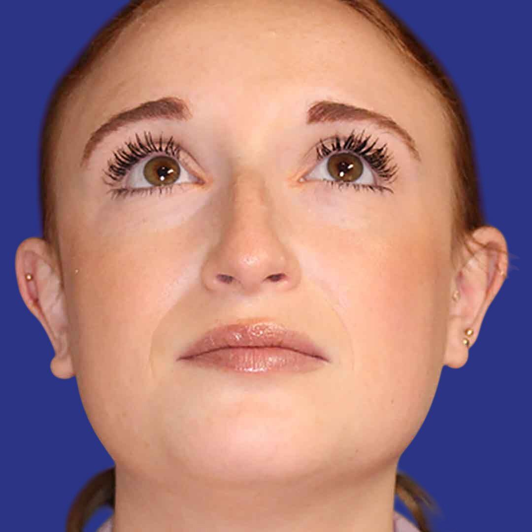Procedure before and after - before