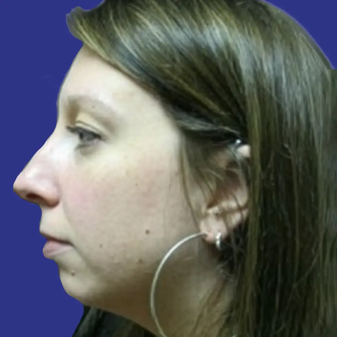 Procedure before and after - before