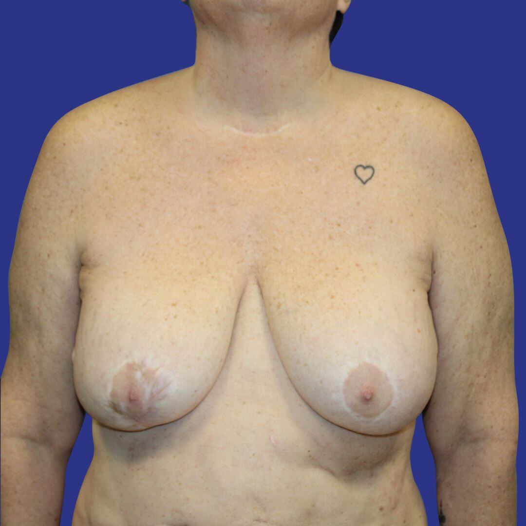 Procedure before and after - before