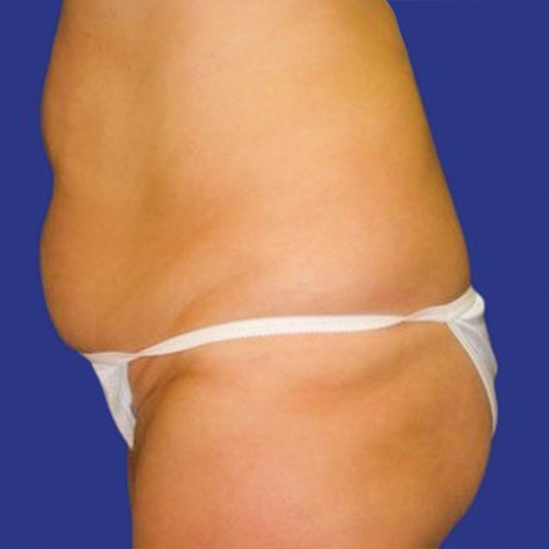 Procedure before and after - before