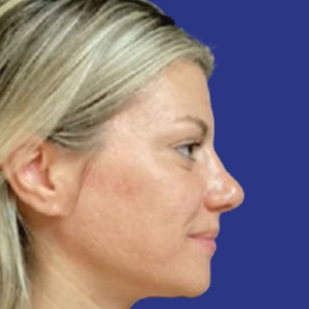 Procedure before and after - before