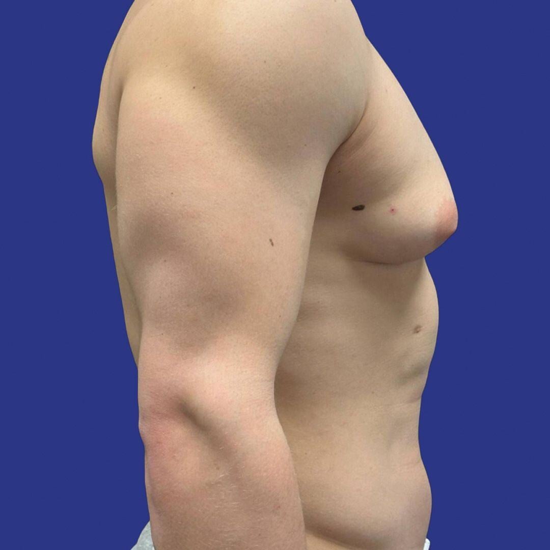 Procedure before and after - before
