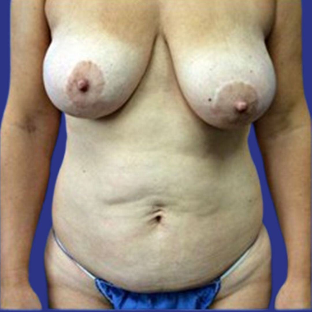 Procedure before and after - before