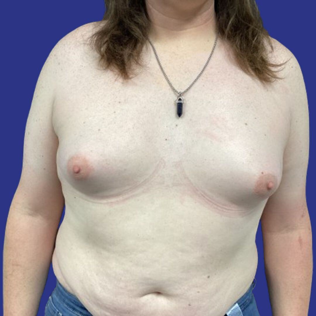 Procedure before and after - before