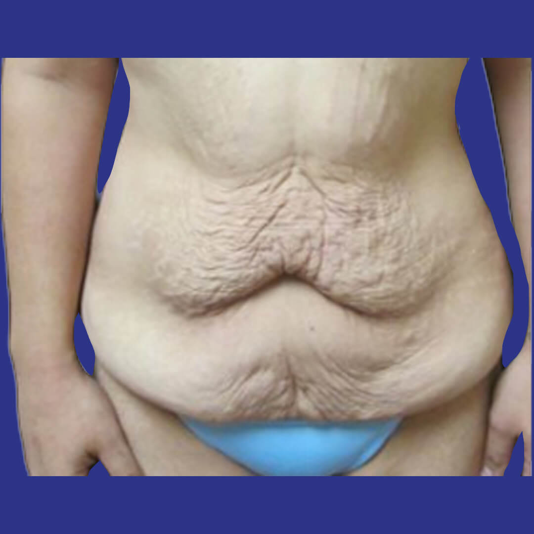 Procedure before and after - before